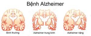 Bệnh Alzheimer: Nguyên nhân, dấu hiệu và cách điều trị